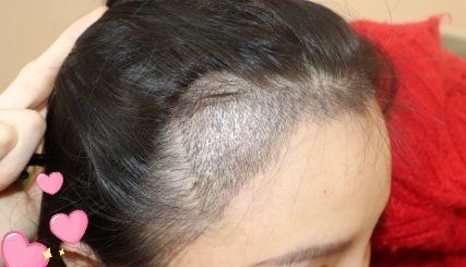 -大麦微针植发丨全国连锁