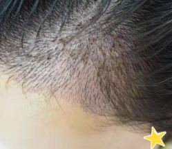 -大麦微针植发丨全国连锁