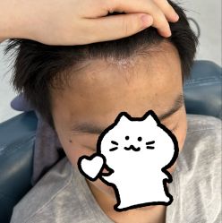 体验后-大麦微针植发全国连锁