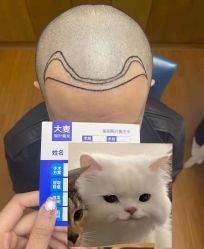 -大麦微针植发全国连锁