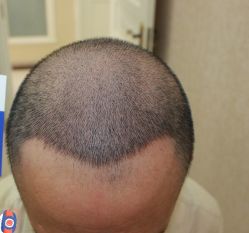 -大麦微针植发丨全国连锁