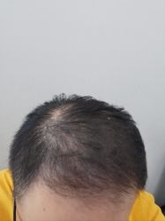 -大麦微针植发丨全国连锁