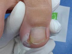 -Andrew指甲专科灰指甲·甲沟炎矫正·3D步态矫形鞋垫定制(上海法华镇路旗舰店)