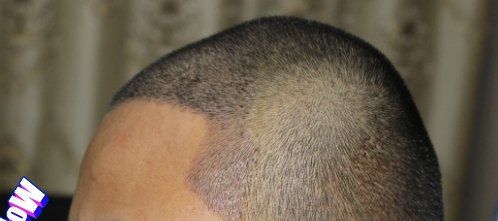 -大麦微针植发丨全国连锁