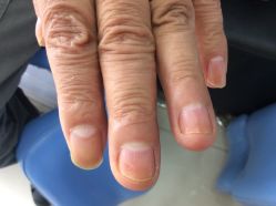 -德哥灰指甲脚气甲沟炎跖疣护理