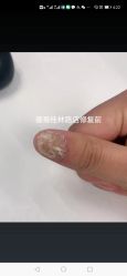 -德哥灰指甲脚气甲沟炎跖疣护理