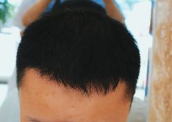 -大麦微针植发全国连锁