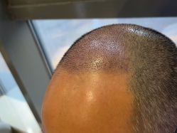 -碧莲盛·不剃发植发