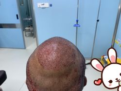 点击看大图 -大麦微针植发丨全国连锁