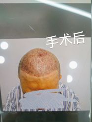 -北京雍禾植发医院