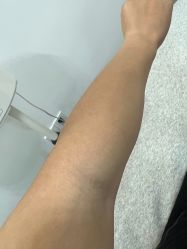 体验后-杭州医巢医疗美容