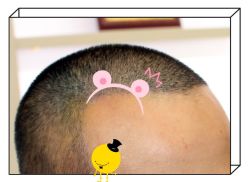 -大麦微针植发全国连锁