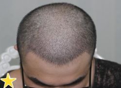 -大麦微针植发丨全国连锁