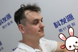 -大麦微针植发丨全国连锁