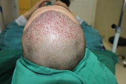 -大麦微针植发丨全国连锁