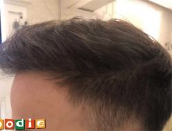 -大麦微针植发全国连锁