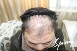 -大麦微针植发全国连锁