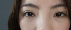 -爱莎扁平疣·汗管瘤·斑痣中心