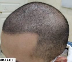 -大麦微针植发丨全国连锁