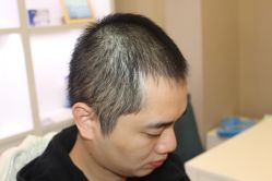 -大麦微针植发丨全国连锁