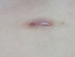 -成都军建医院·疤痕诊疗中心