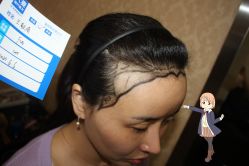 -大麦微针植发丨全国连锁