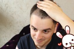 -大麦微针植发丨全国连锁