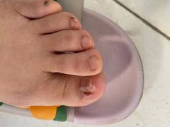 -世龙世家灰指甲鸡眼脚气甲沟炎跖疣护理(通州店)