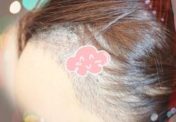 -大麦微针植发全国连锁