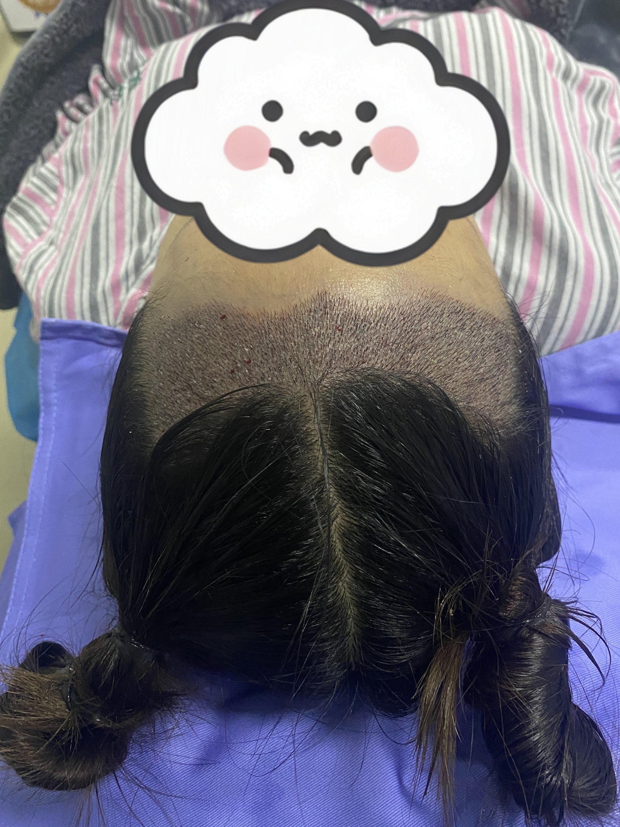 女生可以植发吗(女生可以植发吗有危险吗)