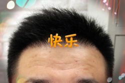 -大麦微针植发全国连锁