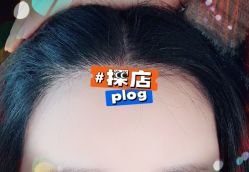 -大麦微针植发全国连锁