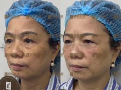 -广州健丽·去眼袋医疗美容机构