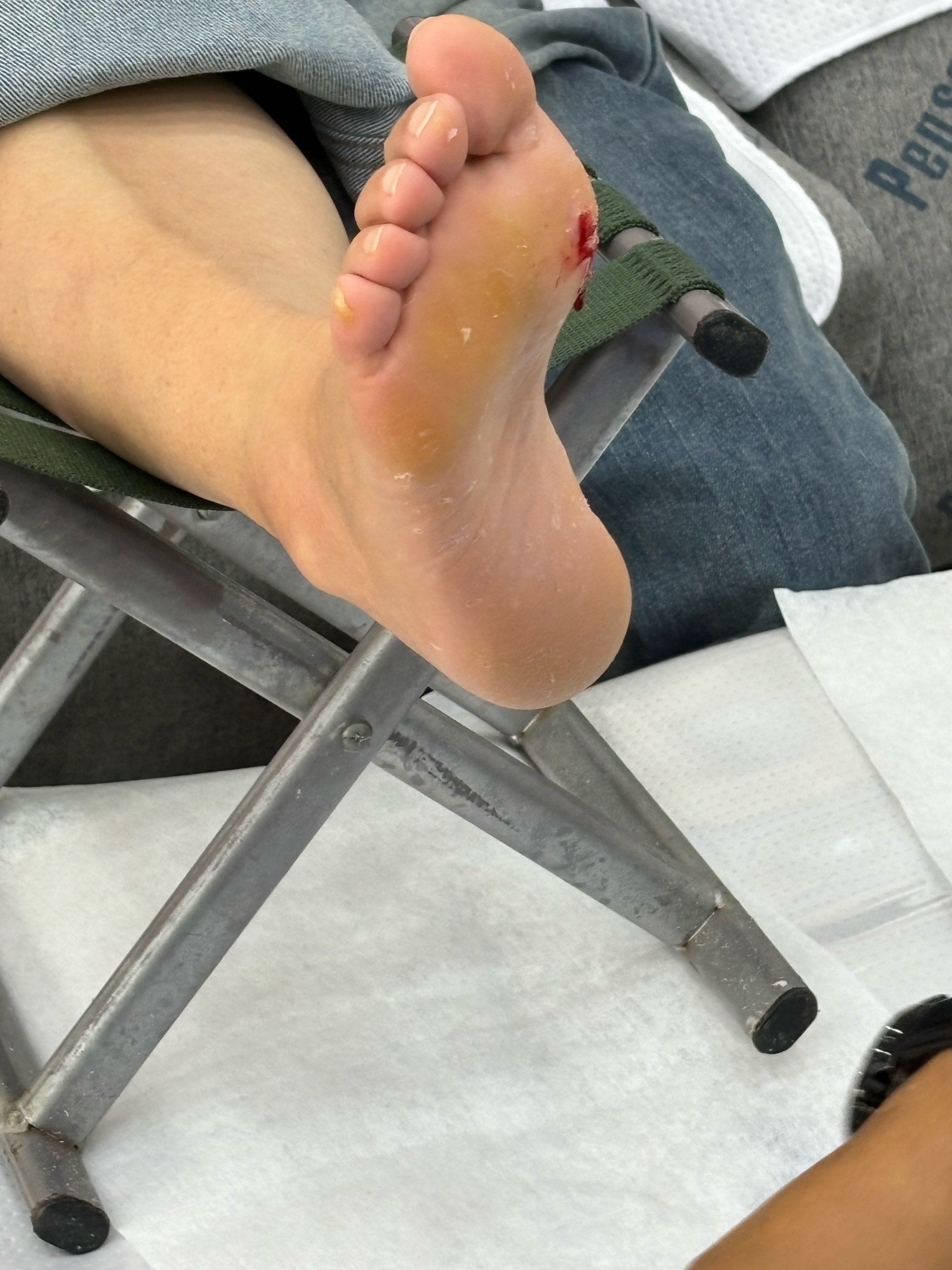 修脚出血感染的案例有吗