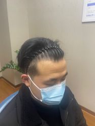 体验后-大麦微针植发全国连锁