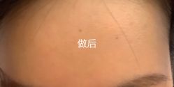 -爱莎扁平疣·汗管瘤·斑痣中心