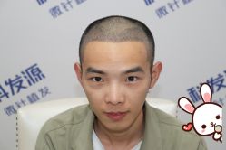 -大麦微针植发丨全国连锁