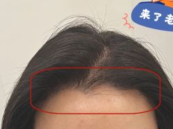 -大麦微针植发全国连锁