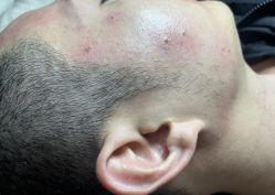 体验后-痣斑堂·取大痣