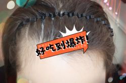 -大麦微针植发全国连锁