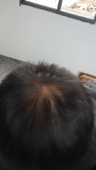 -碧莲盛·不剃发植发