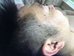 -爱莎扁平疣·汗管瘤·斑痣中心