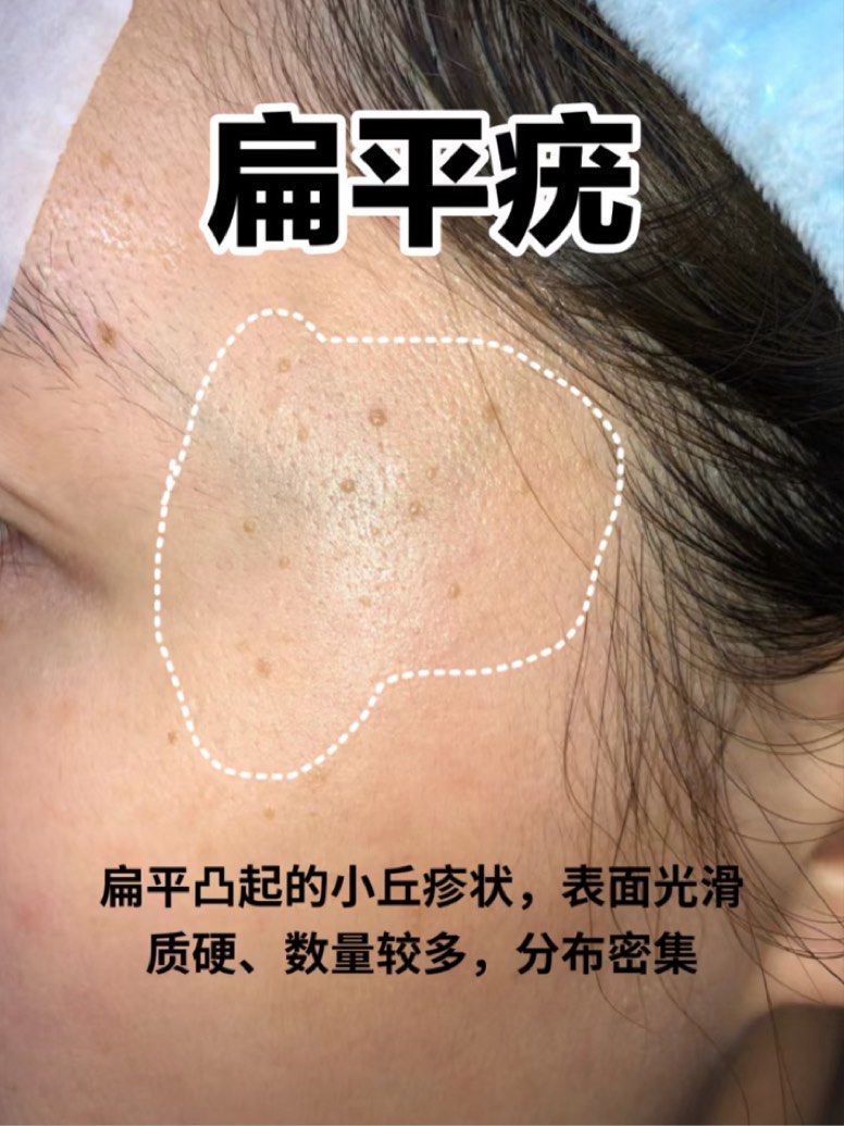 你为什么会得扁平疣