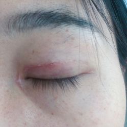 点击看大图 体验后-深圳美莱医疗美容医院