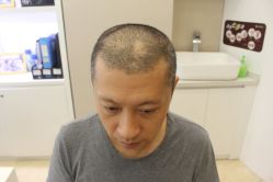 -大麦微针植发丨全国连锁