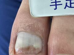 -Andrew指甲专科灰指甲·甲沟炎矫正·3D步态矫形鞋垫定制(浦三路店)