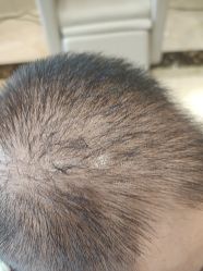 -碧莲盛·不剃发植发