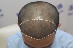 -大麦微针植发丨全国连锁