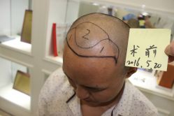 -大麦微针植发丨全国连锁