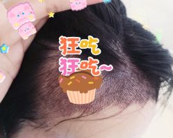 -大麦微针植发全国连锁